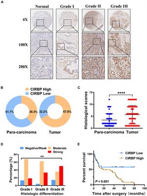 CIRBP Knockdown Attenuates Tumourigenesis and Improves the Chemosensitivity of Pancreatic Cancer via the Downregulation of DYRK1B